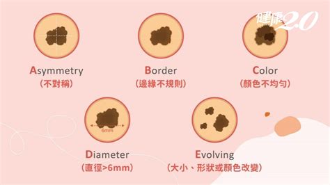 生黑痣|是痣or皮膚癌？醫「1張圖秒對照」 長這2部位最危險